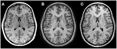 Lifespan Volume Trajectories From Non–harmonized T1–Weighted MRI Do Not Differ After Site Correction Based on Traveling Human Phantoms